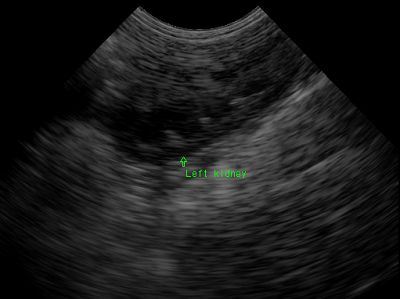Left kidney
